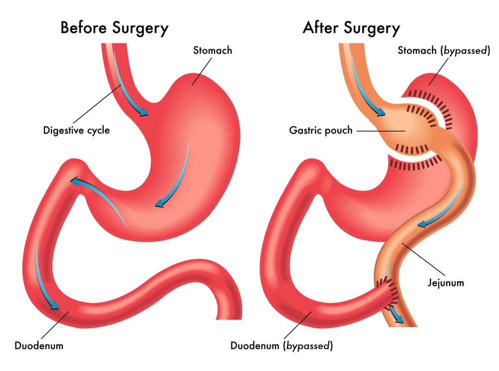 Slim Surgical Gastric Bypass Before and After Surgery