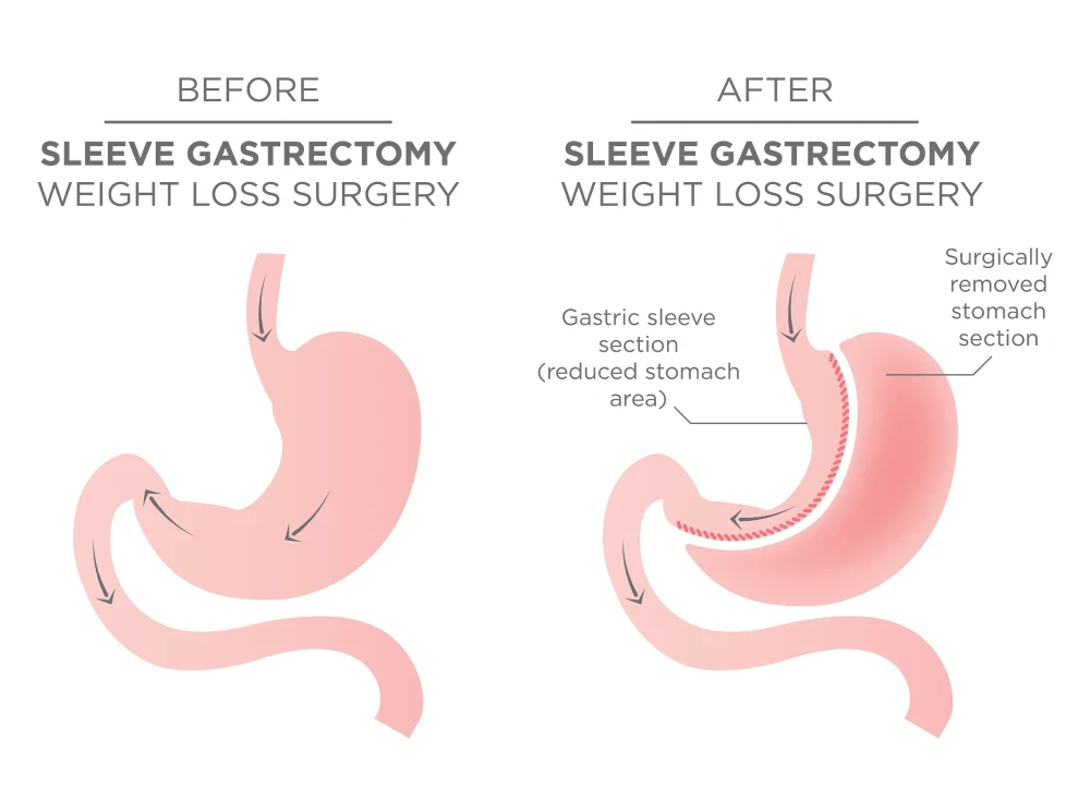 Gastric Sleeve Surgery Before and After