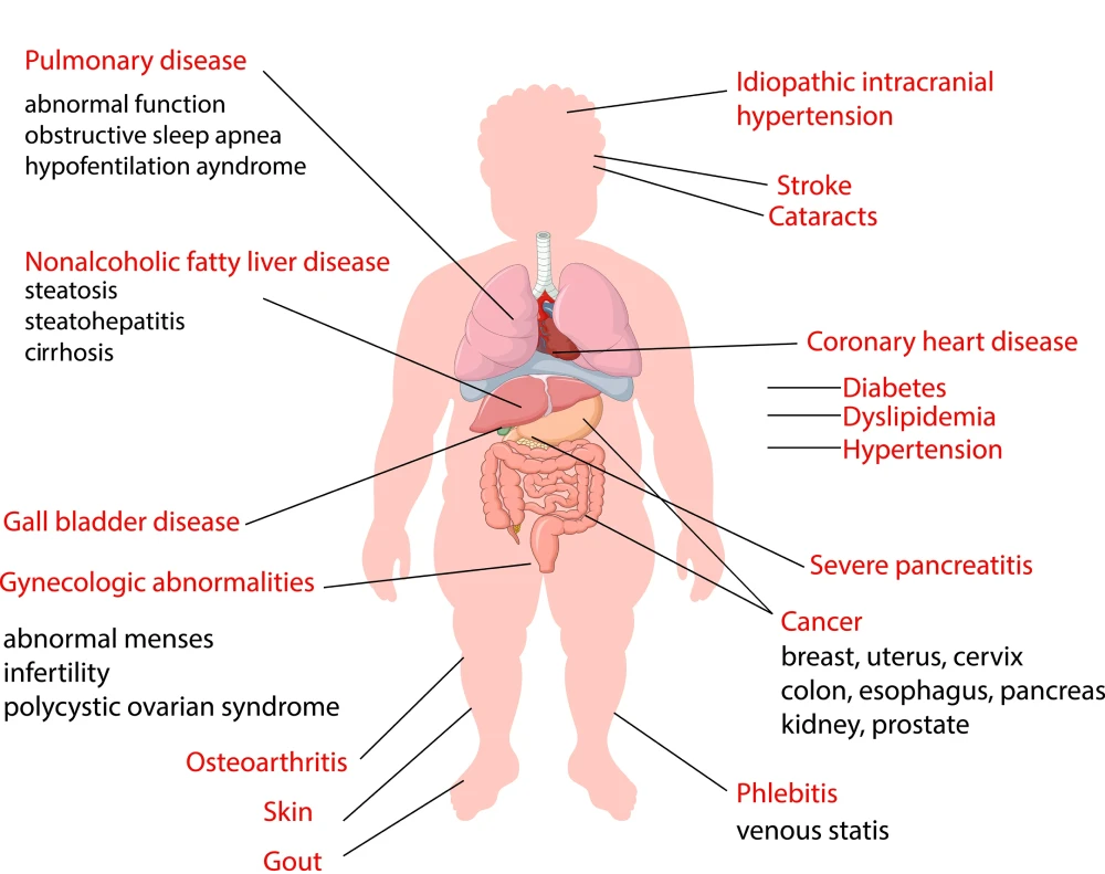 Medical Complications of Obesity